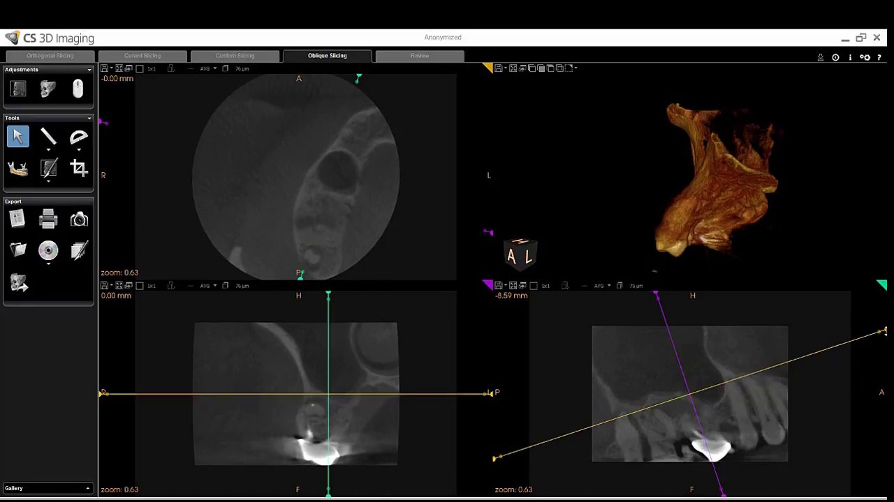 Carestream 3D Imaging Endo CBCT Case Presentation - 90003D Dr. John Panzarino