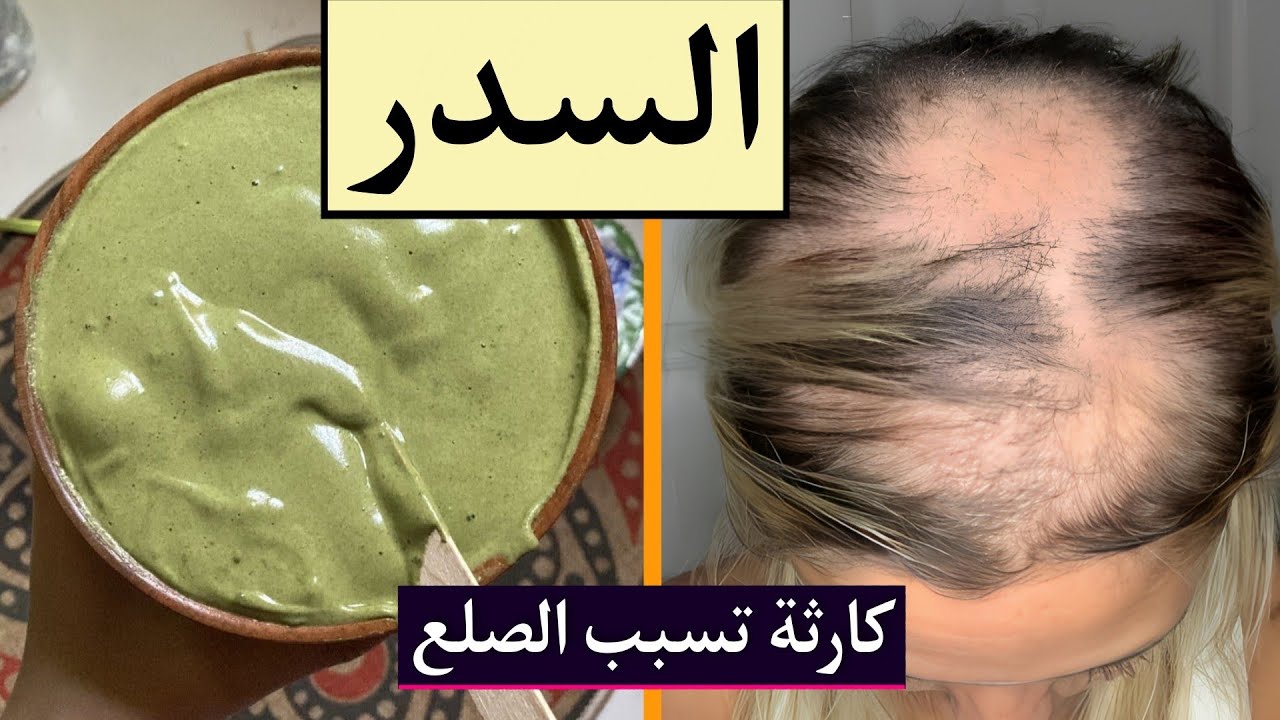 ماسك السدر المطحون كارثة تسبب الصلع و بالدليل