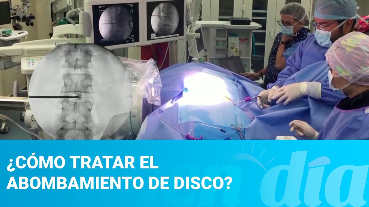 ¿Cómo tratar el abombamiento de disco?