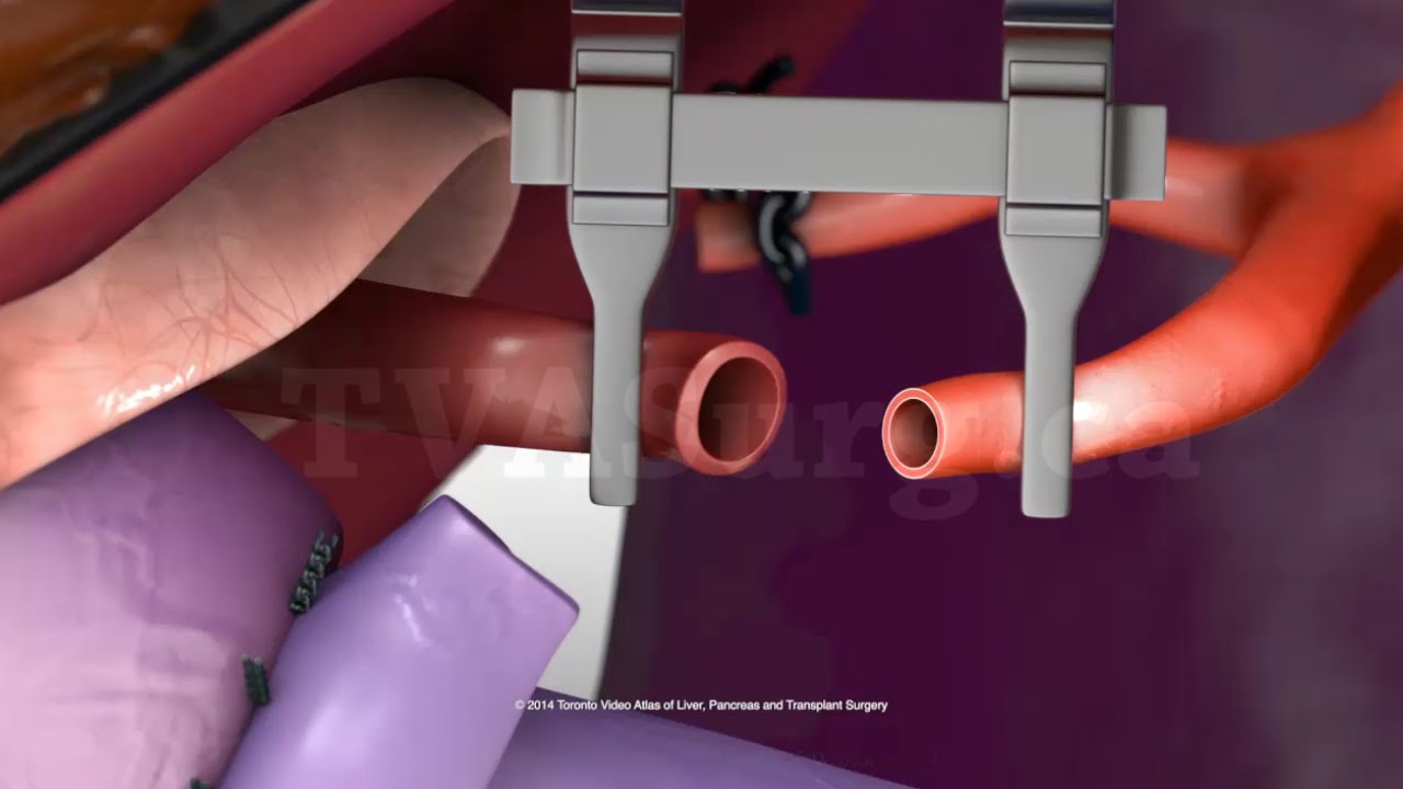 Pediatric hepatic artery reconstruction technique