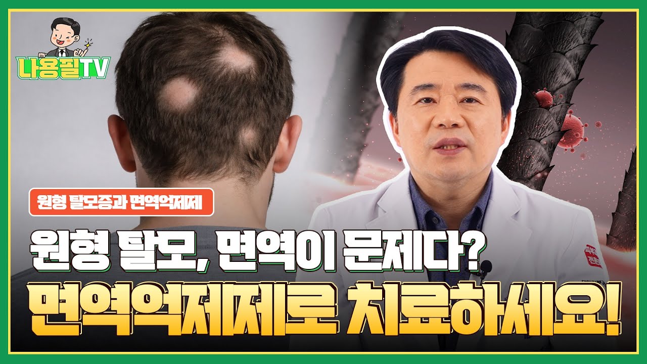 원형 탈모증에서 유용한 면역억제제 치료! #광주탈모치료 #광주모발이식