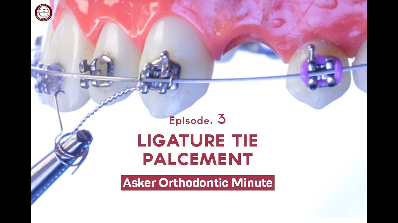 LIGATURE TIE (Asker Orthodontic Minute) Episode. 3
