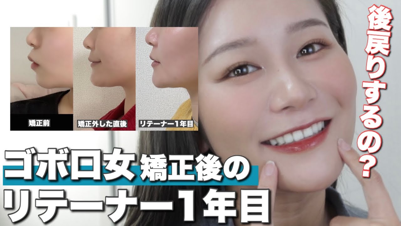 【矯正後1年目】リテーナー生活。矯正した歯は後戻りするの？ホワイトニング/歯のケアについて🦷【ゴボ口】