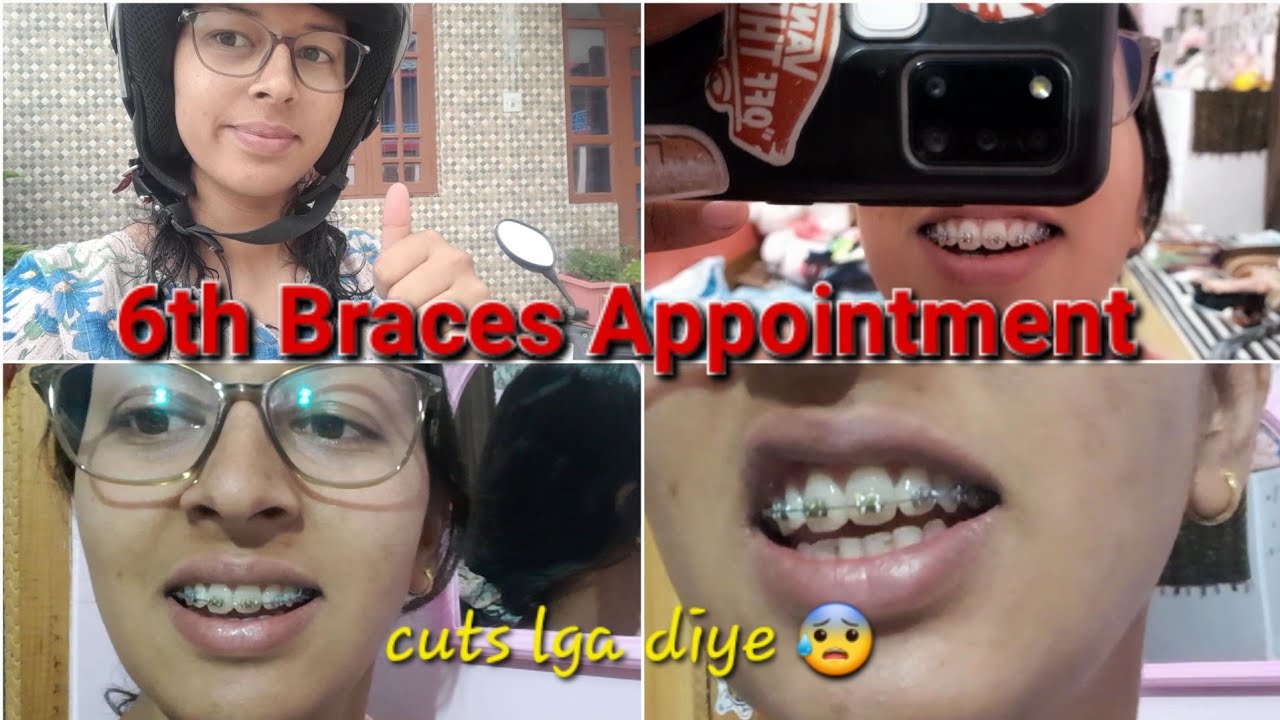6th Braces Appointment 😬 || Teeth Ko Cut Kr Diya|| 