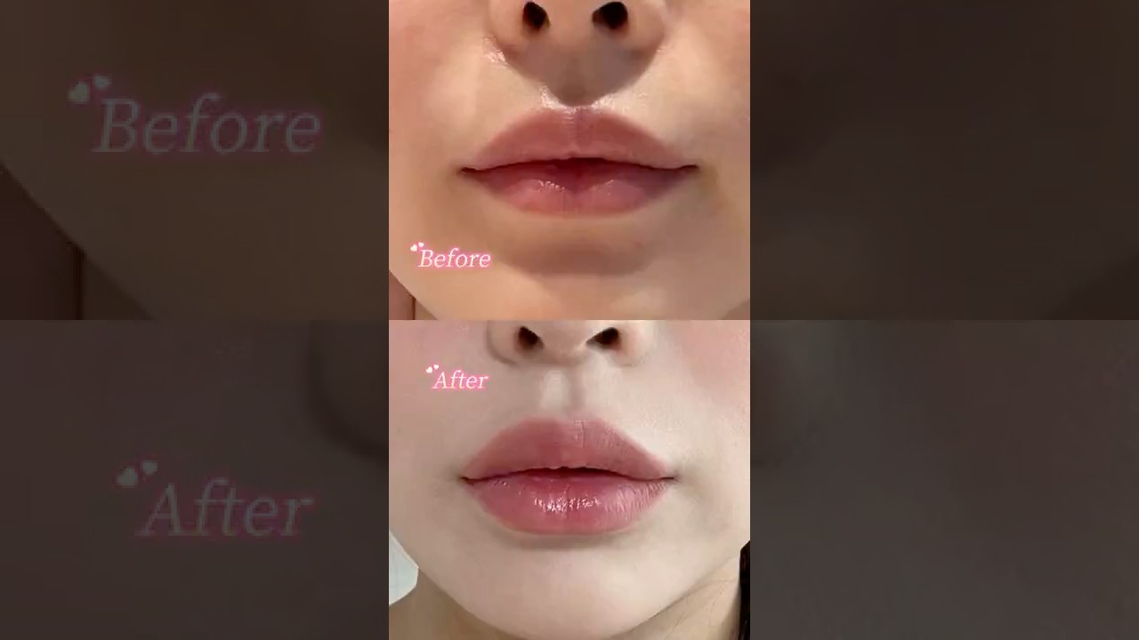 이번 #입술필러 인생 입술필러다..👍🏻✨ 첫 수입필러 #입술필러후기
