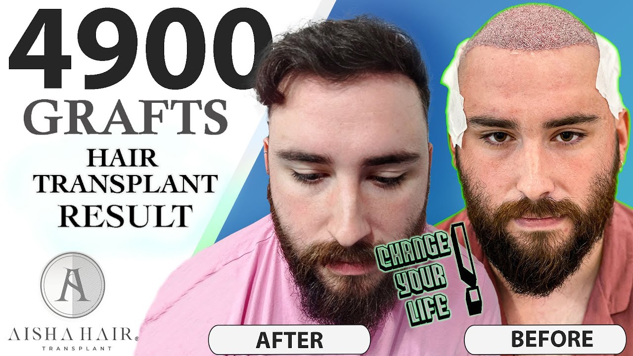4900 GRAFTS | Norwood 5A FUE Hair Transplant Turkey| 4900 FOLÍCULOS | Norwood 5A Injerto Capilar FUE