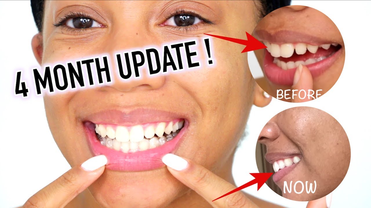 UPDATE ON MY INVISALIGN JOURNEY + PICTURES | ALMOST DONE!