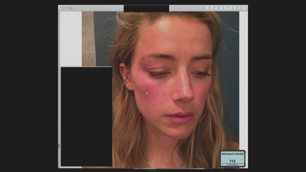 Johnny Depp's lawyers question alleged injuries Amber Heard documented after altercation with Depp