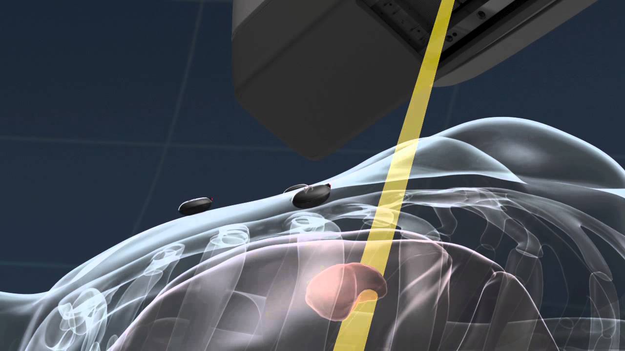 CyberKnife Treatment Overview