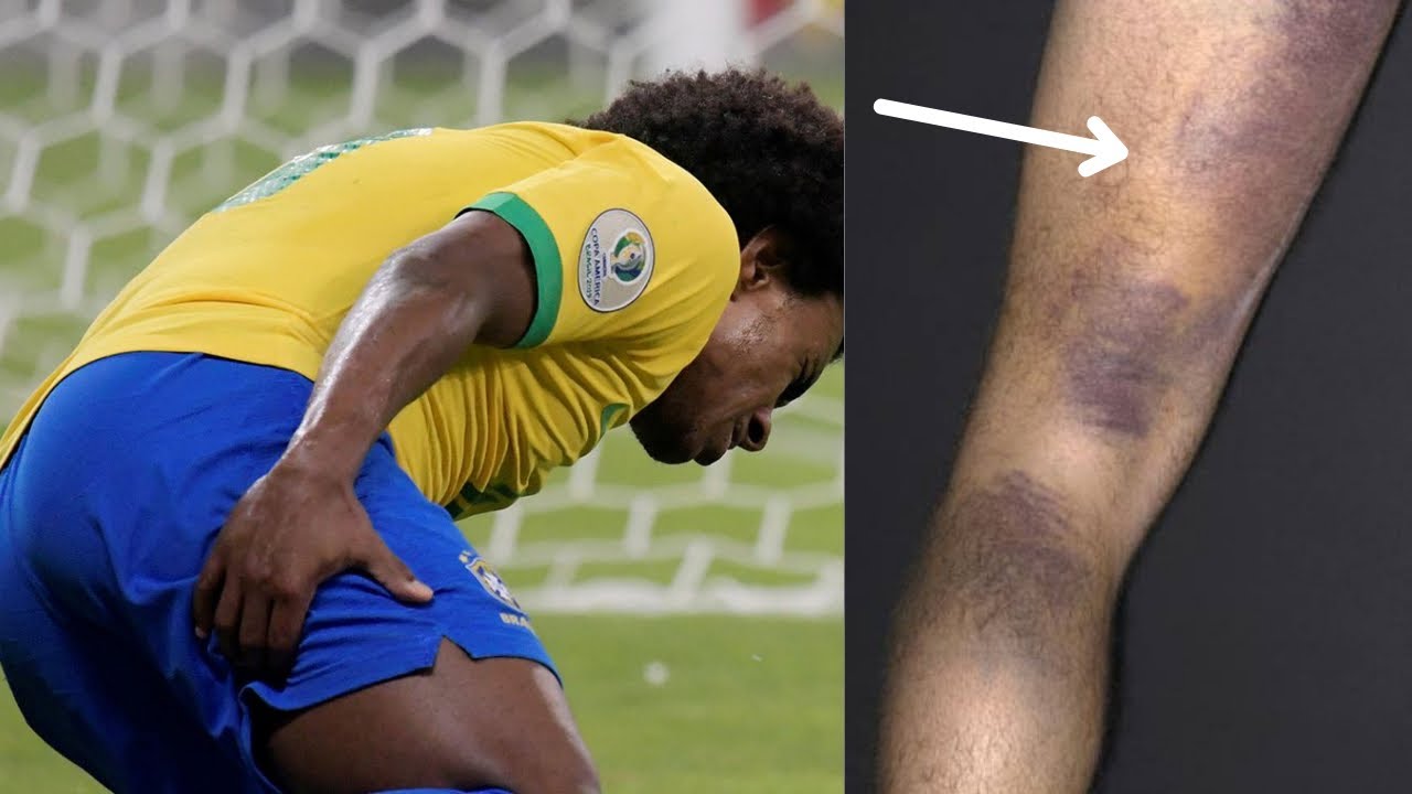 Lesão na posterior da coxa - jogando futebol #musculo #futebol