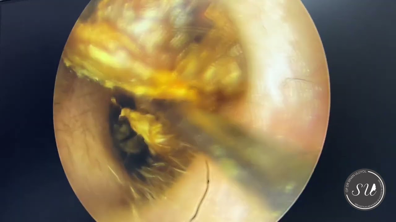 Earwax removal by Dr Uluyol / Kulak kiri temizliği #earwaxremoval #earwax