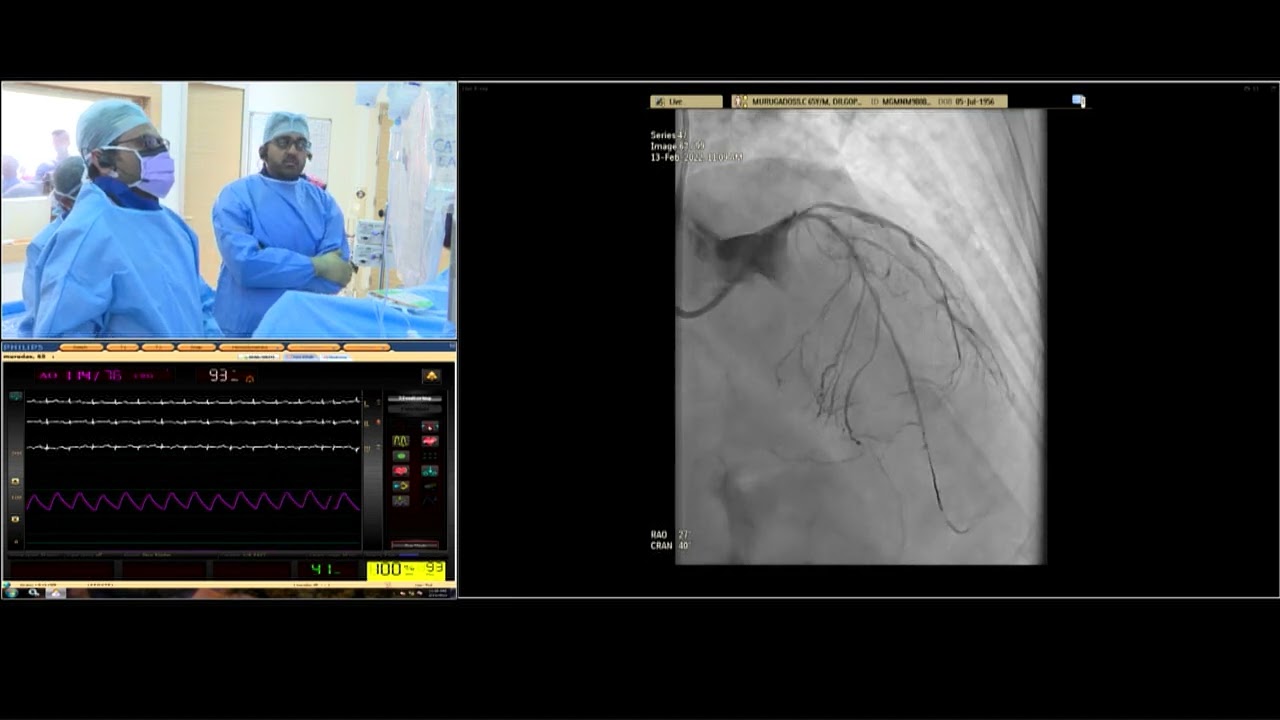 Complex LM Bifurcation Angioplasty by Dr A B Gopalamurugan and team - Lithotripsy, DK Crush & OCT