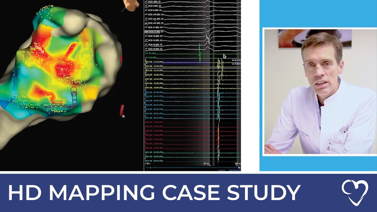 Case Study: Catheter Ablation of Ventricular Tachycardia with HD Mapping