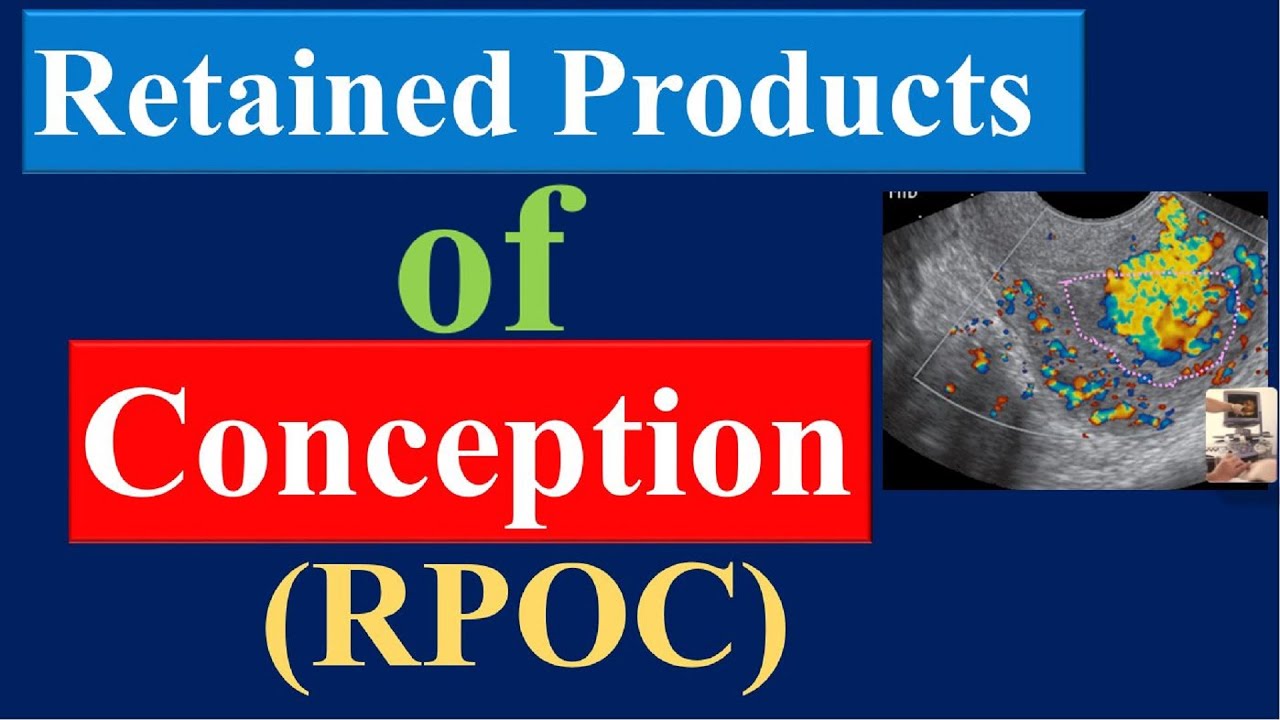STOP Misdiagnosing Retained Products of Conception!