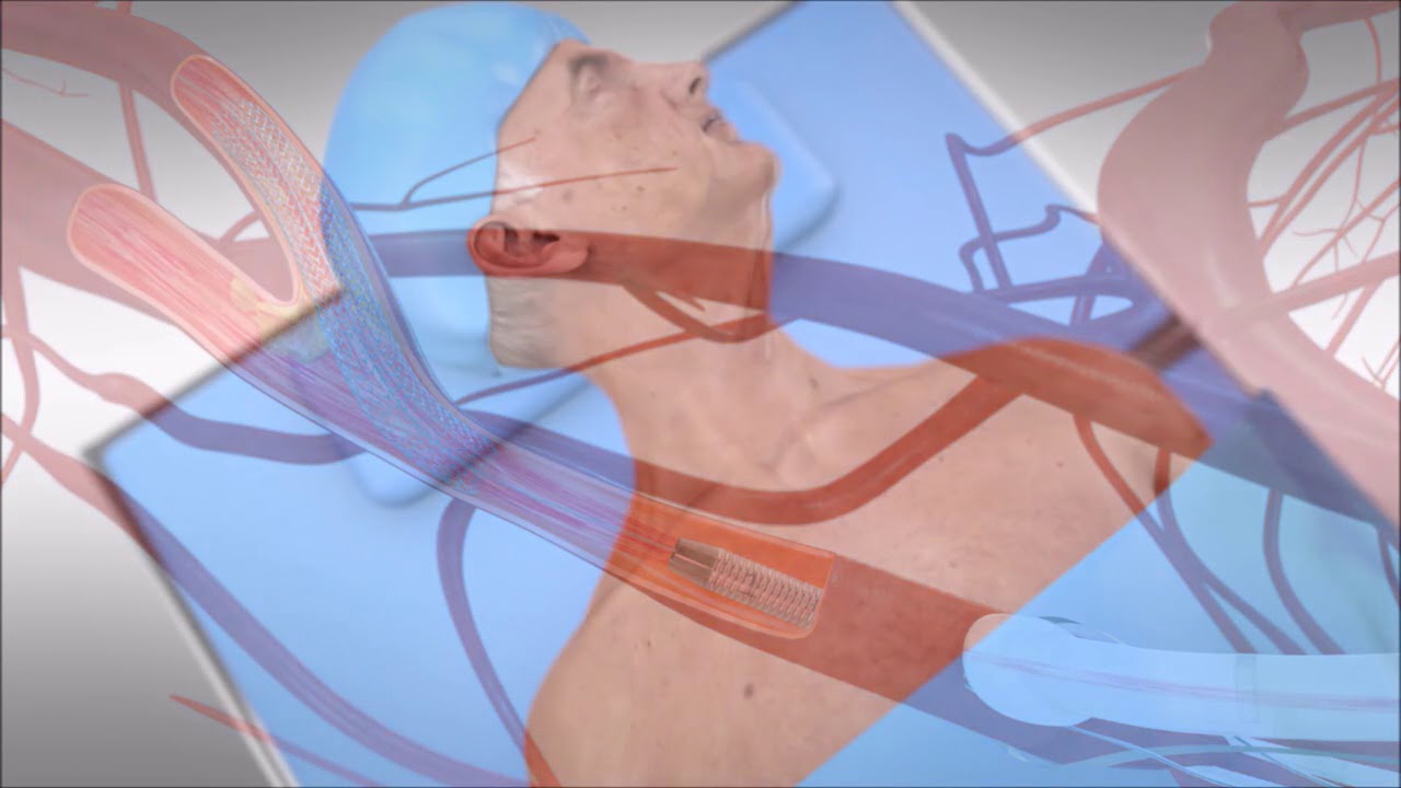 TransCarotid Artery Revascularization (TCAR)