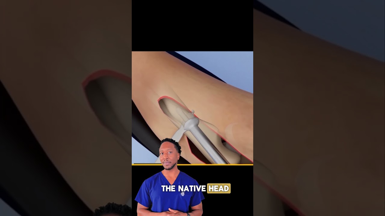 ⚙️RadialHeadReplacement: Restoring Elbow Function 