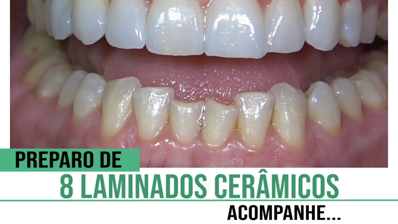 Preparo de 8 laminados cer&acirc;micos.