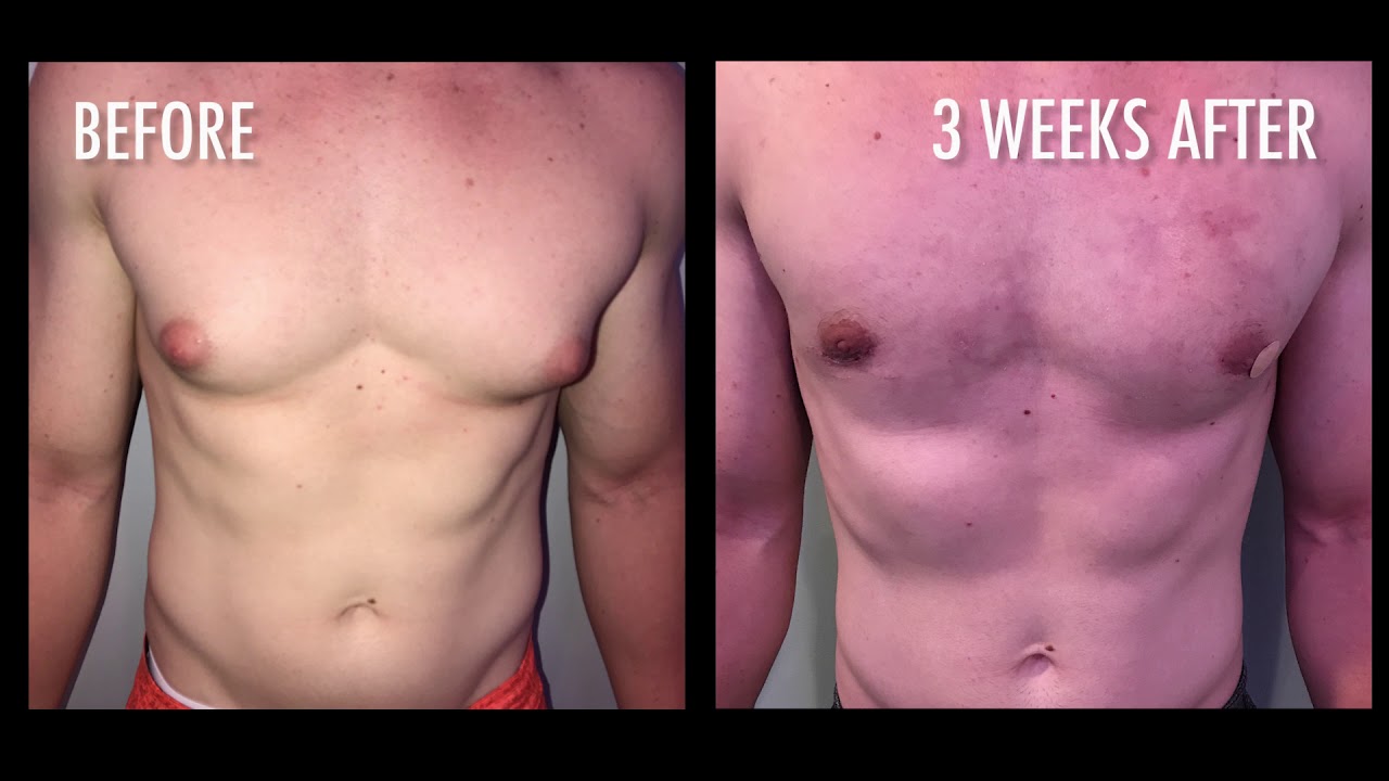 Gynecomastia (Male Breast Reduction) Video Review - S. Larry Schlesinger, Honolulu Plastic Surgeon