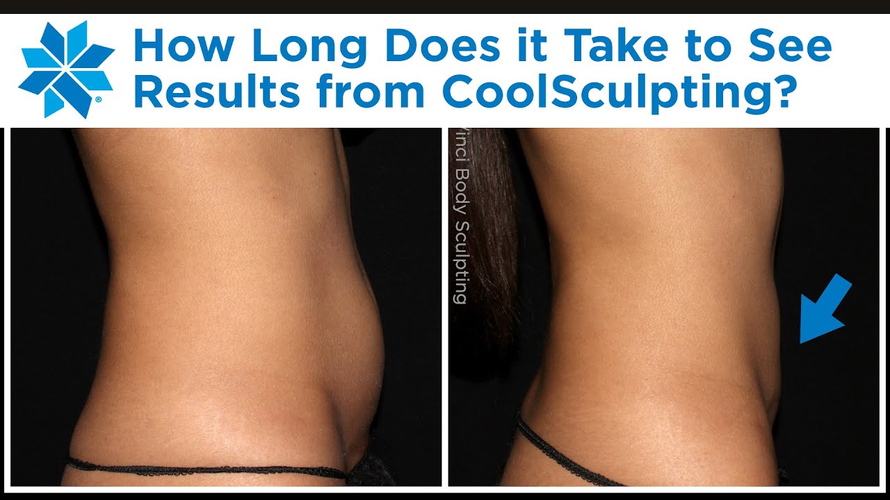 How Long Does It Take to See CoolSculpting Results?
