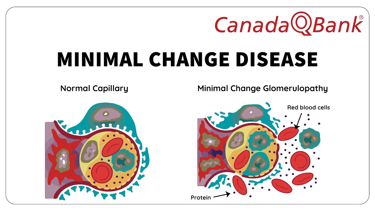 Minimal Change Disease (MCD): Causes, Symptoms & Treatment | Nephrotic Syndrome | CanadaQBank