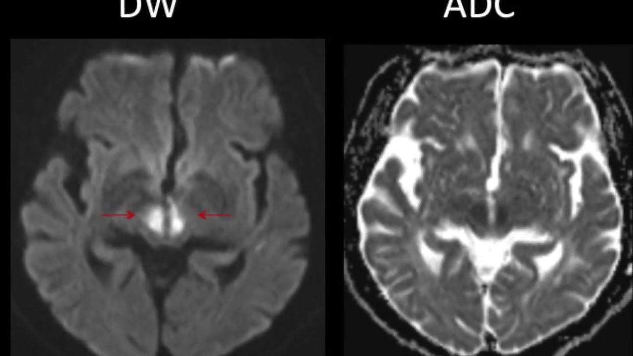 TMT: NEURORADIOLOGY SHORT CASES SERIES : Case 1