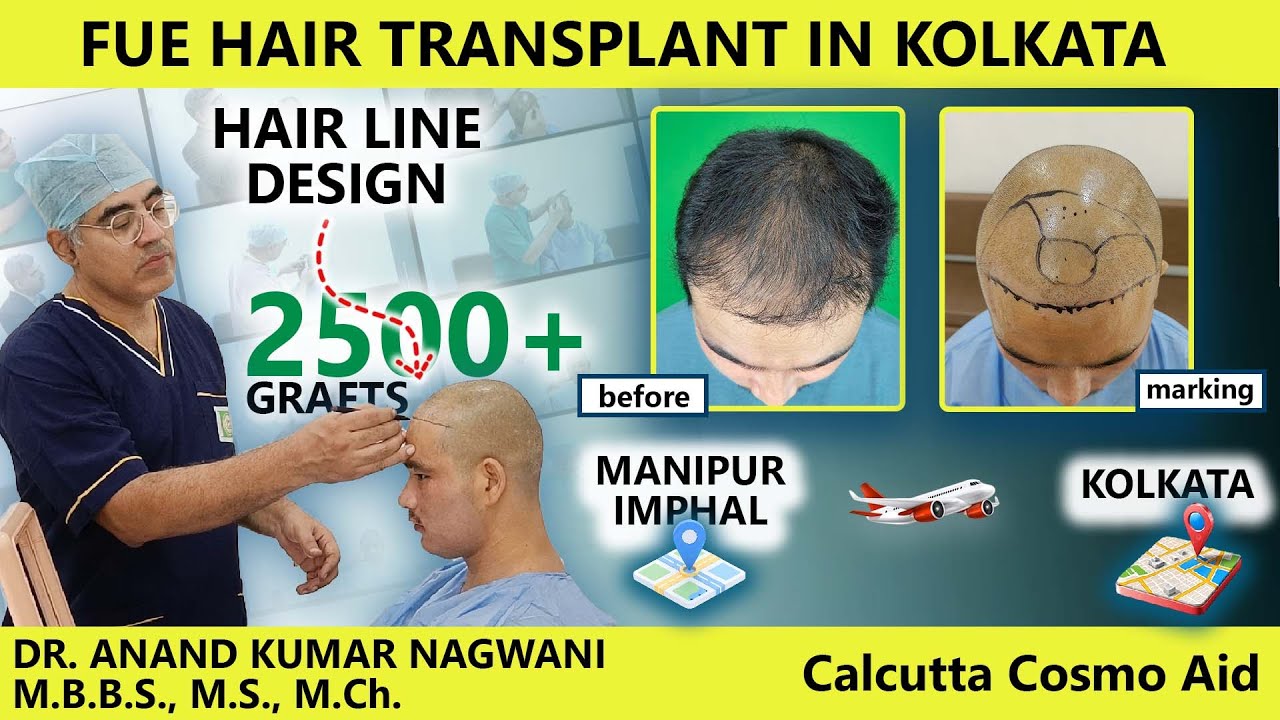 Best Hair Transplant in Kolkata | FUE Hairline design(2500+ Grafts) by Dr Nagwani|Calcutta Cosmo Aid