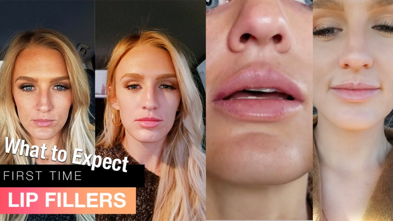 My first time getting LIP FILLERS before AND after - 1 syringe Juvederm Ultra