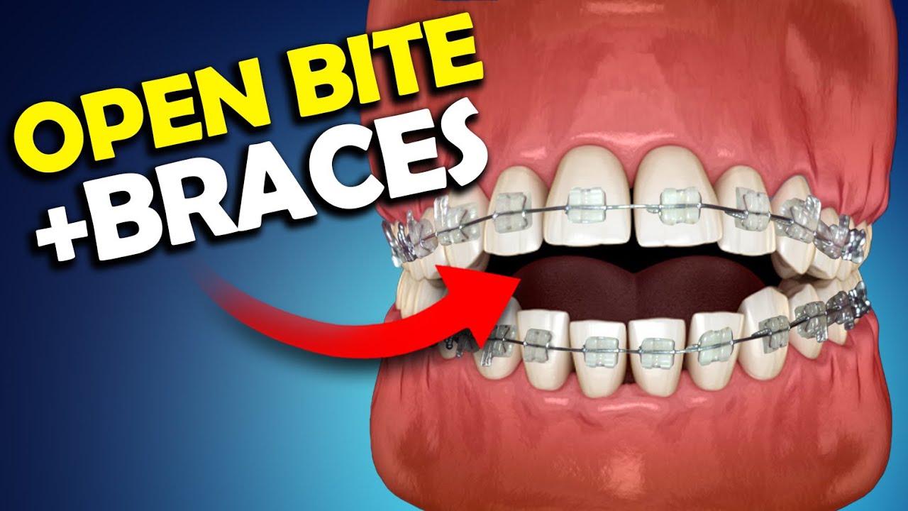 How Do Braces Fix Open Bites? | Packard Family Orthodontics