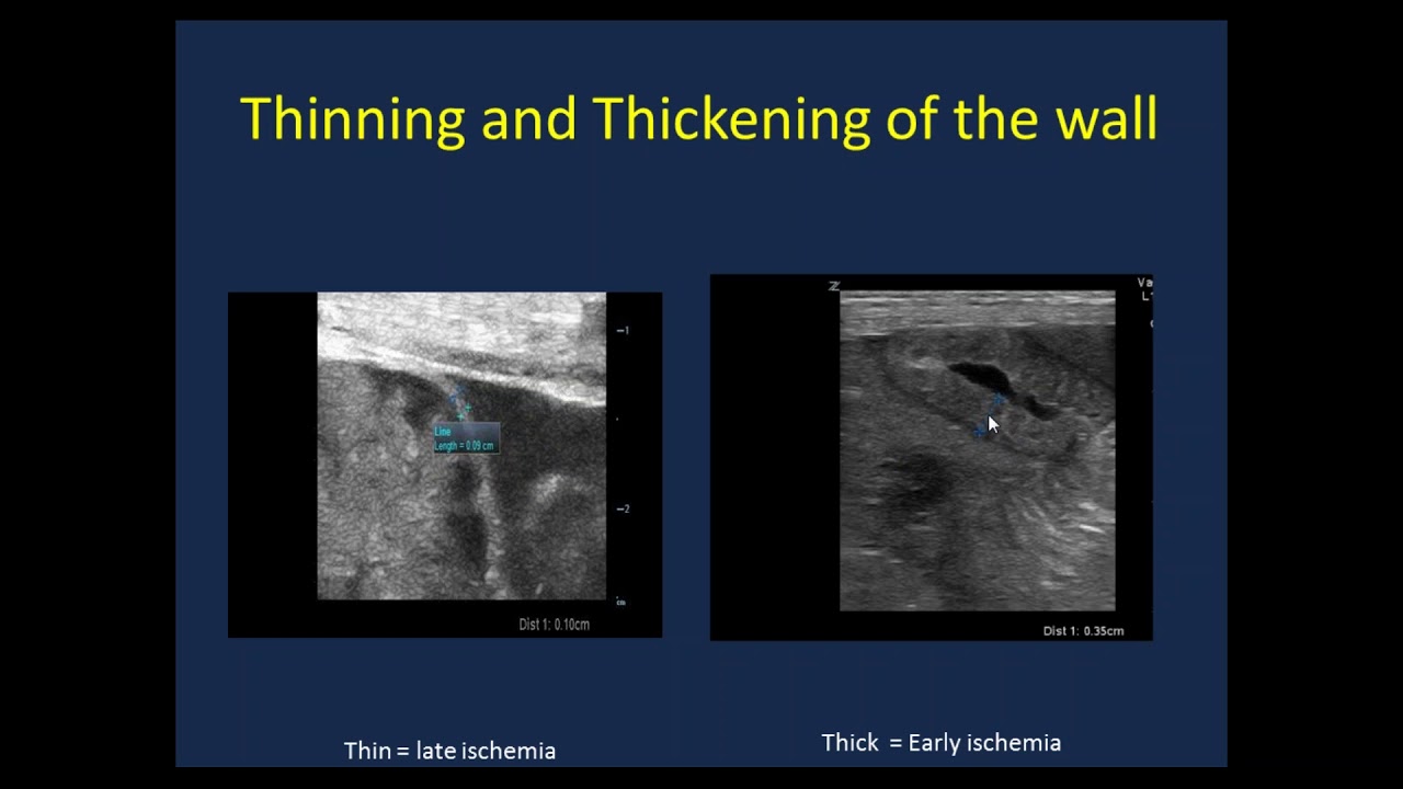 Point of Care Neonatal Ultrasound