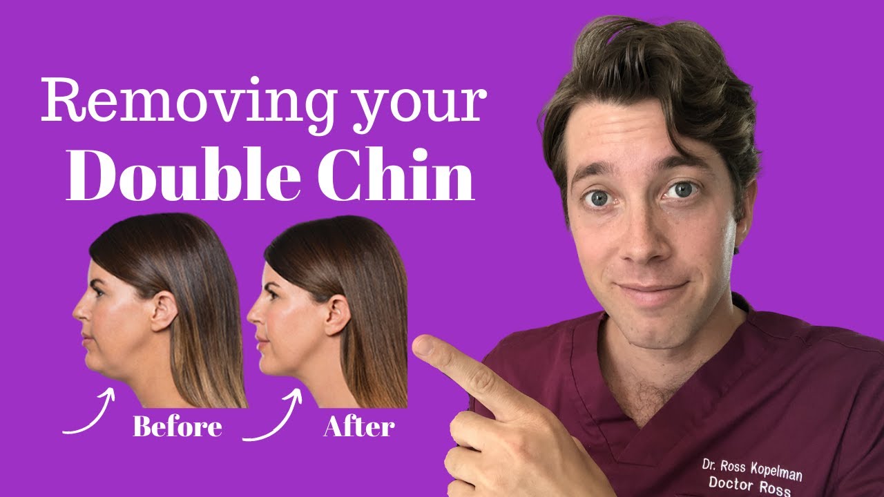 What is Kybella? | Double Chin Remover | Dr. Kopelman
