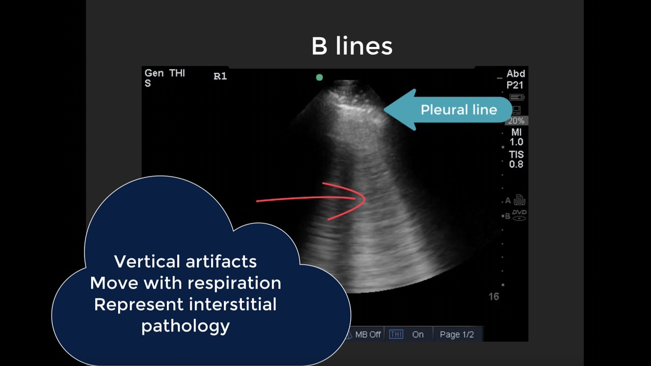 Lung Ultrasound Image Acquisition