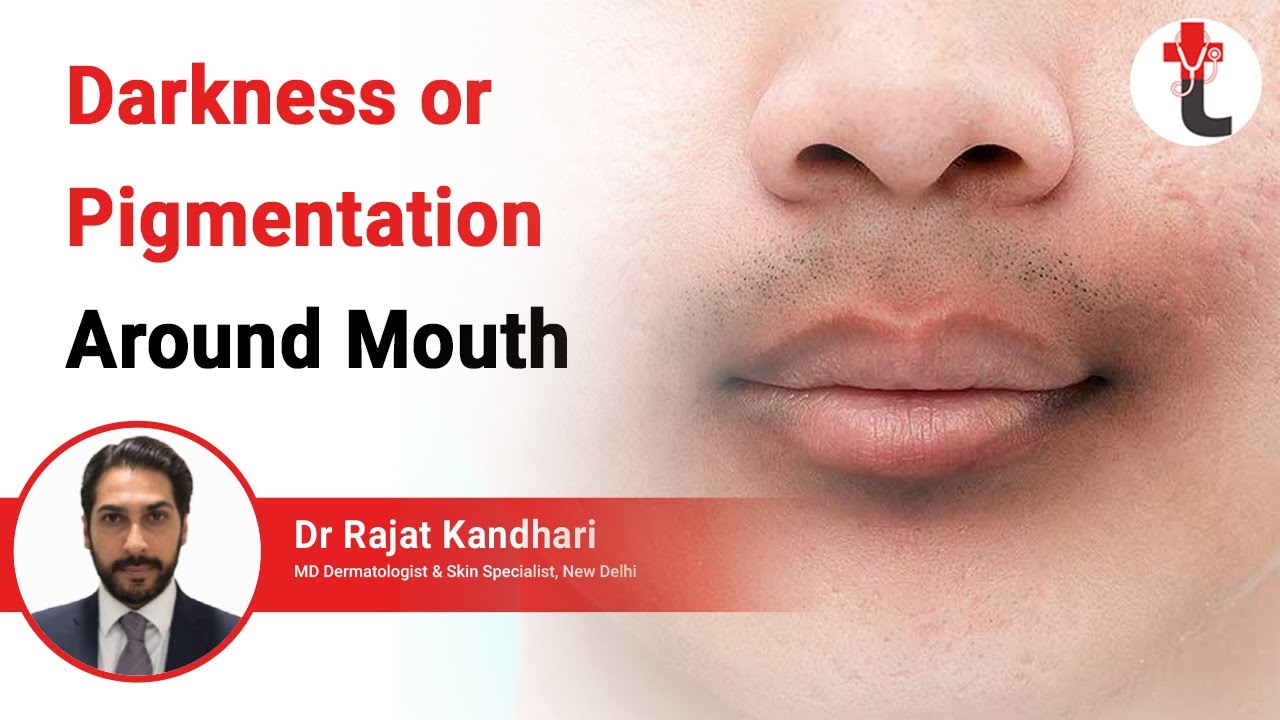 Darkness or Pigmentation Around Mouth || Darkening Around Mouth Causes | Treatment | Dermatologist