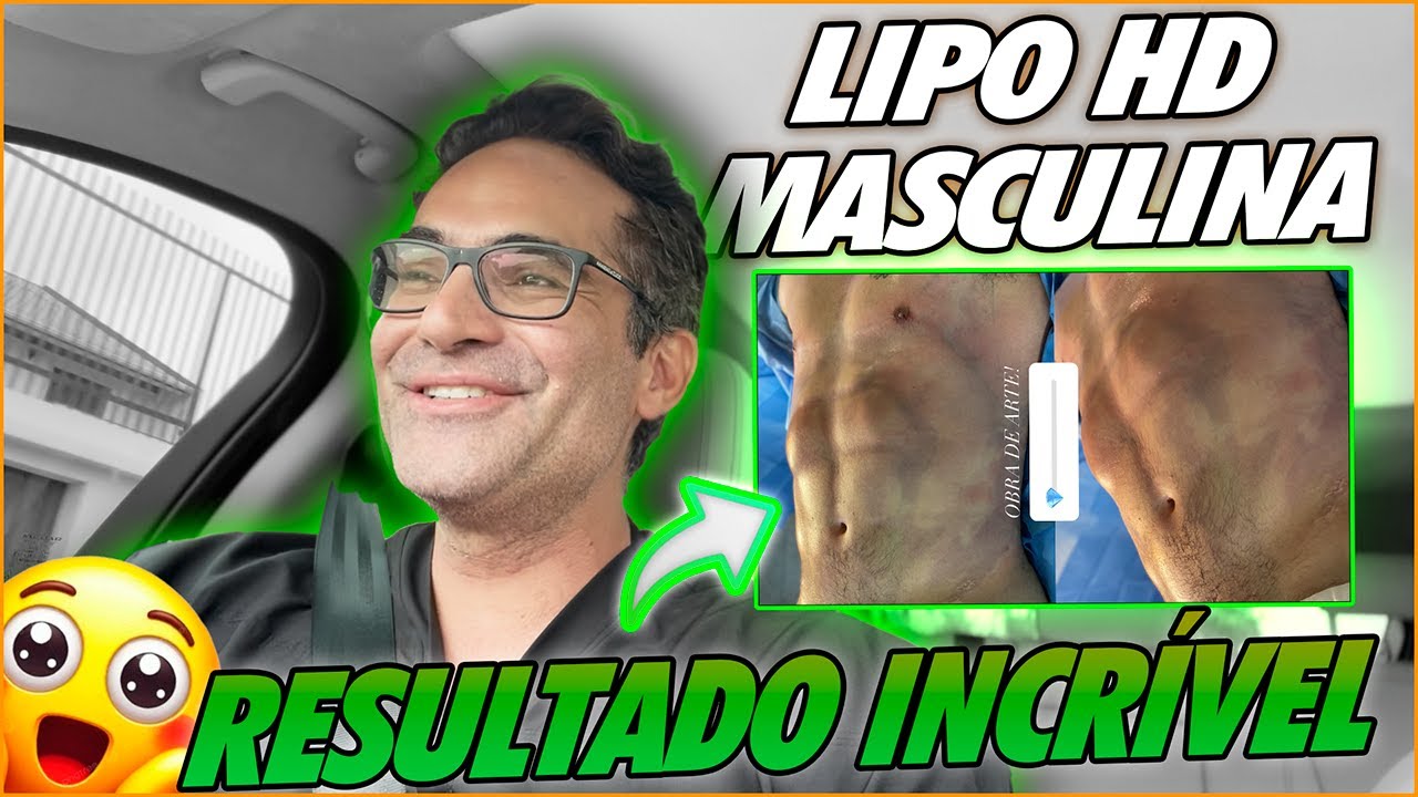 LIPO HD MASCULINA: ANTES E DEPOIS DA TRANSFORMAÇÃO | RESULTADO SURPREENDENTE!