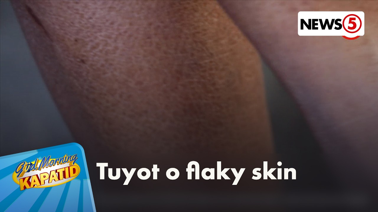 Health check: Kung hindi fungal infection, hindi nakakahawa ang dry skin | Gud Morning Kapatid