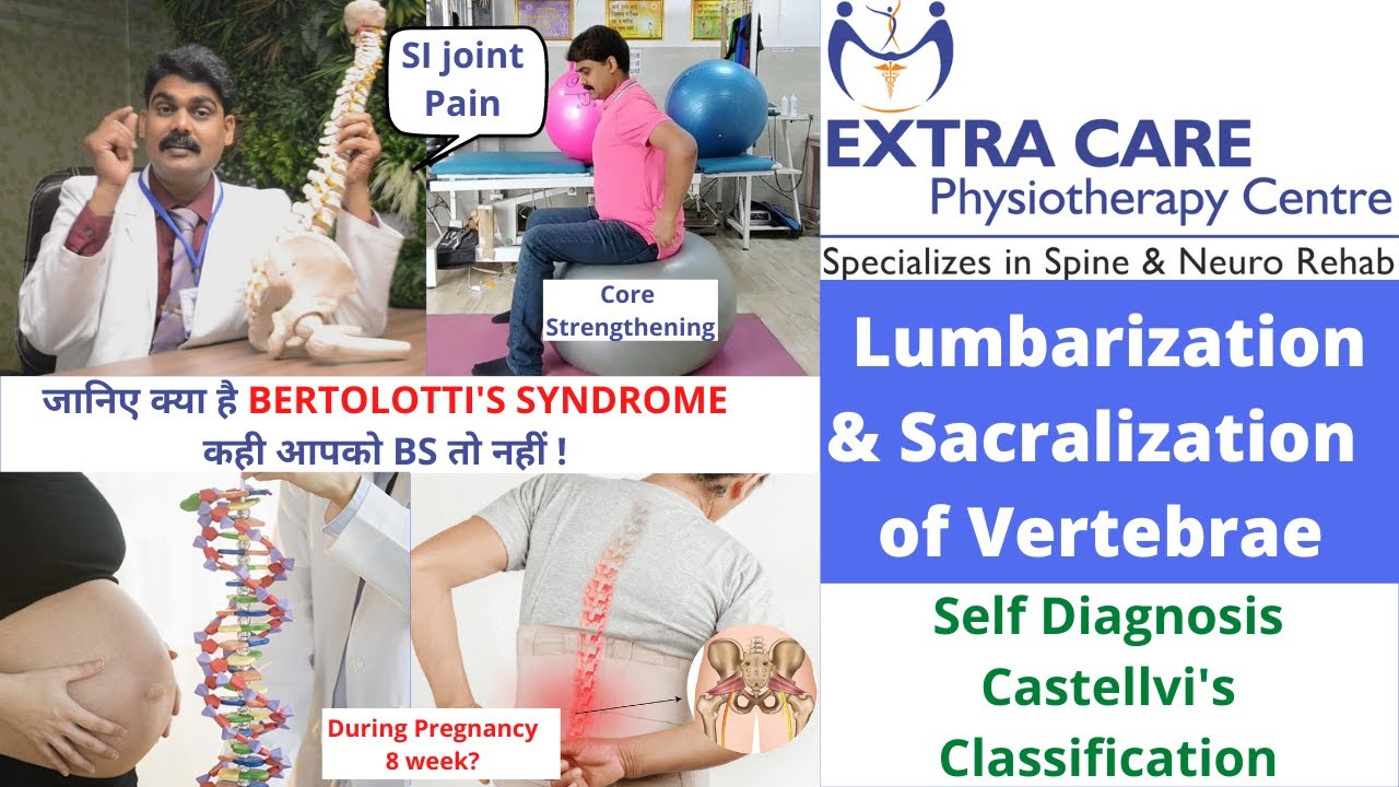 Lumbarization & Sacralization (L5-S1) of Vertebrae | Self Diagnosis & Physiotherapy Treatment