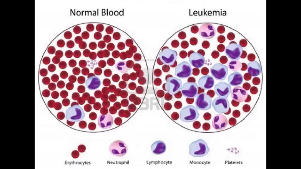What is Leukemia by Lanka Hospitals