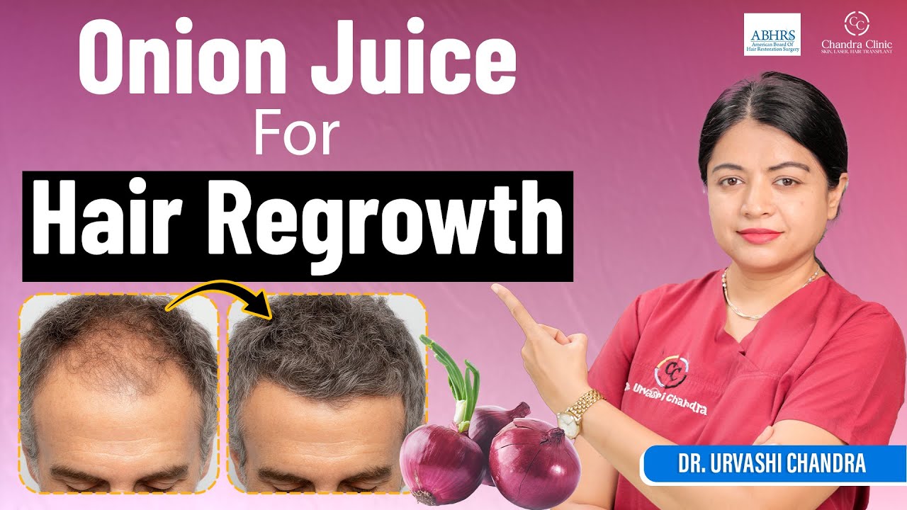 Onion Juice for Hair Growth: Myth or Magic? Dr. Urvashi Chandra Breaks It Down | Chandra Hair Clinic