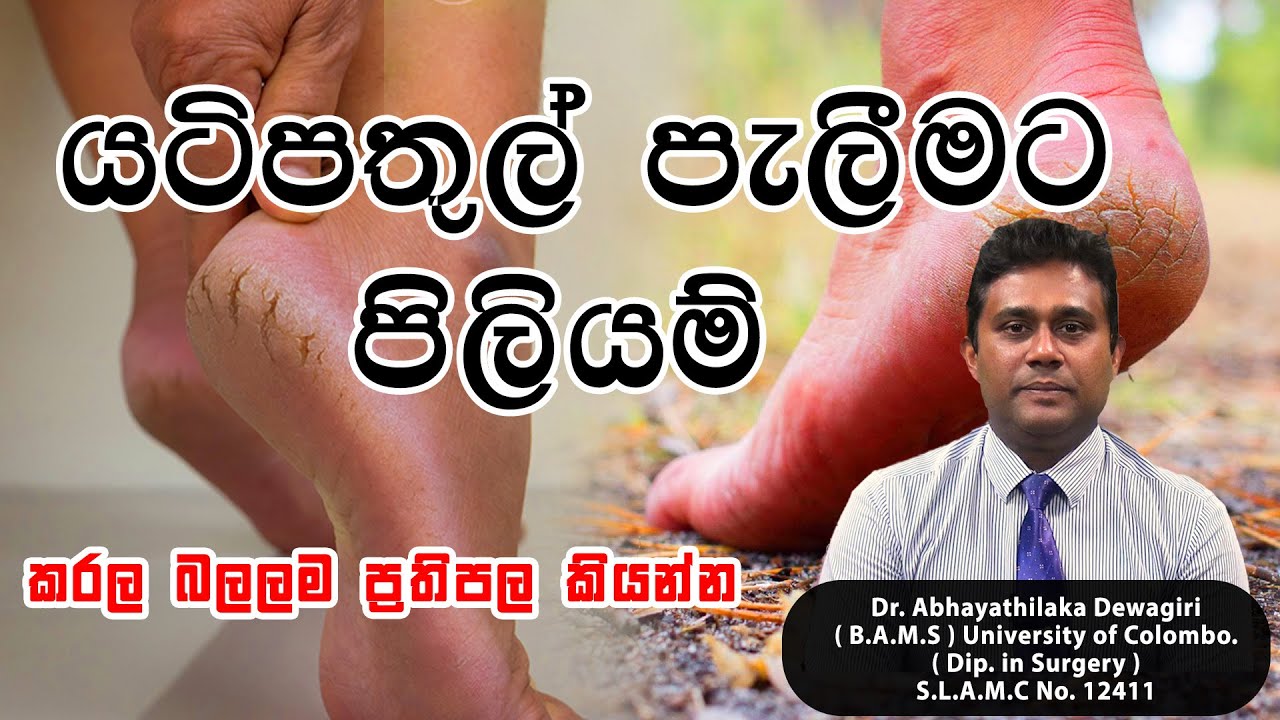 යටි පතුල් පැලීම | Yatipathul Paleemata Piliyam |Cracked heels treatment | Dr. Abhayathilaka Dewagiri