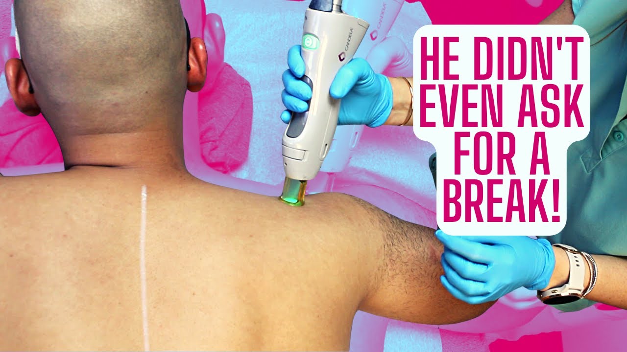 ASMR LASER HAIR REMOVAL | MEN'S FULL BACK & SHOULDERS HAIR REMOVAL | CANDELA GENTLEMAX PRO