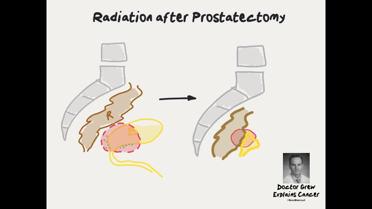 Doctor Explains Radiation for Rising PSA after Prostate Cancer Surgery