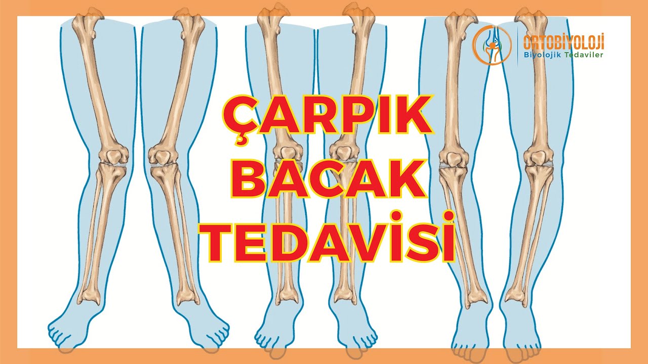 ÇARPIK BACAK SORUNLARI VE ÇARPIK BACAK TEDAVİLERİ