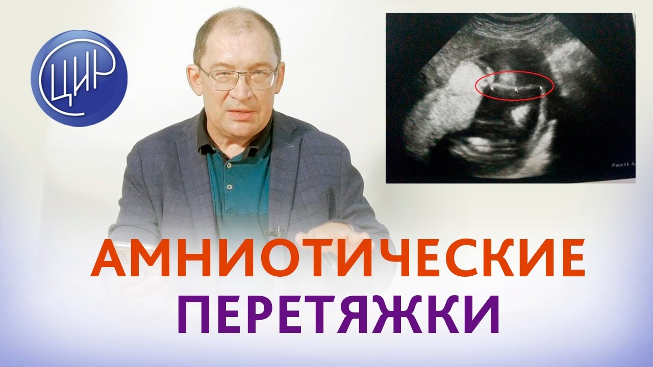 Амниотические перетяжки. Опасны ли амниотические тяжи? Отвечает Игорь Иванович Гузов.