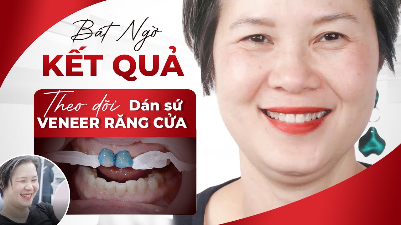 Theo Dõi Trực Tiếp Dán Sứ Veneer Răng Cửa: Bất Ngờ Trước Sự Thay Đổi Của Chị Tú! Nha khoa Sdental