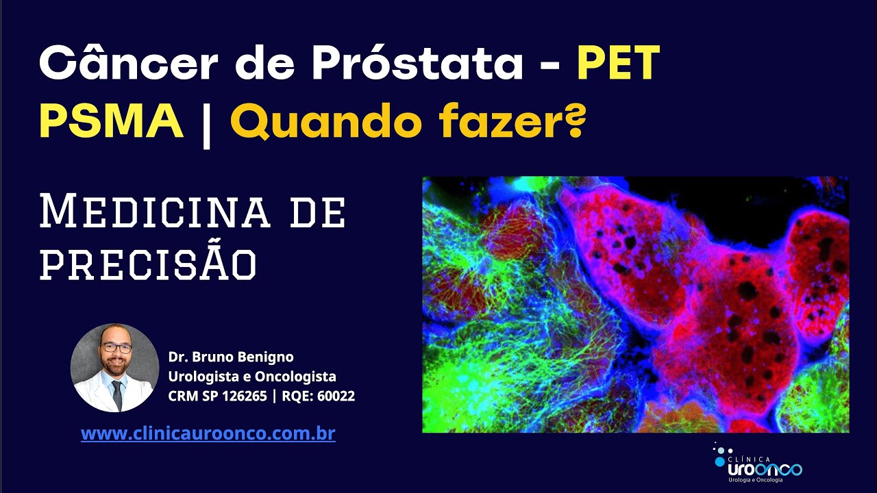 Exame detecta o Câncer de Próstata com metástases. Como PET SCAN com PSMA pode mudar o tratamento?