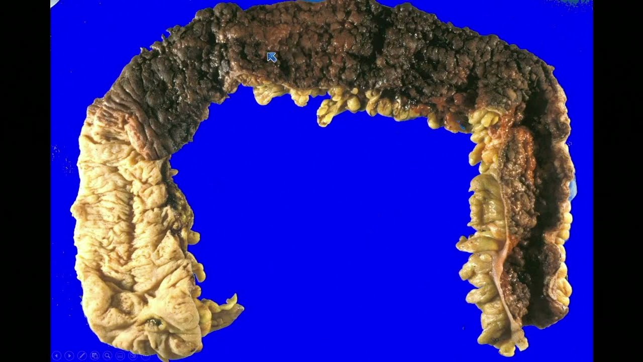 2024 Surgical Pathology Update: Diagnostic Pearls for the Practicing Pathologist: Vol. VIII