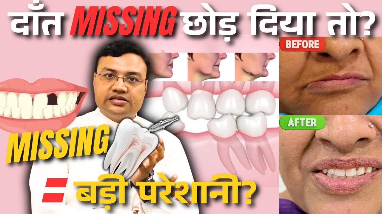Missing Teeth सिर्फ़ gap नहीं, ये एक Chain Reaction शुरू करता है- Dr. Kapil Gupta