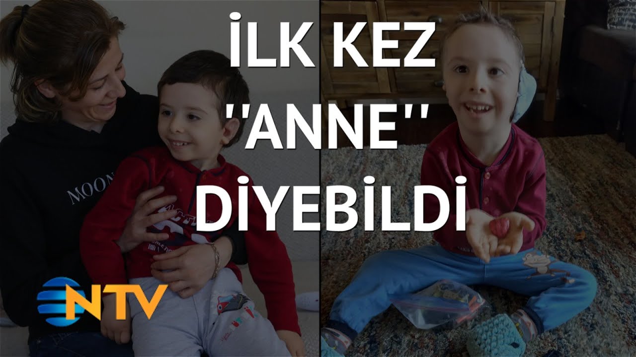 @NTV  Doğuştan iki kulağı olmayan Alperen’e 3 boyutlu yazıcıyla kulak yapıldı