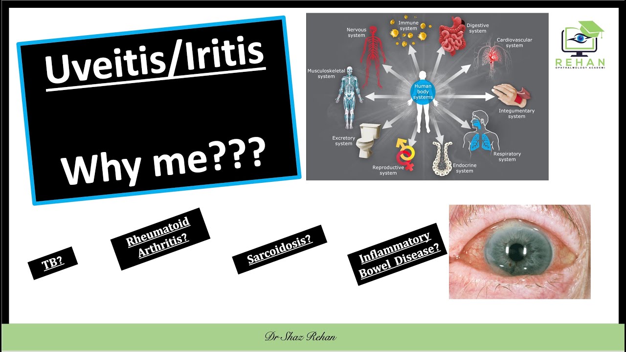 Why Have I Developed Uveitis? Why Me? What Are The Systemic Causes of Uveitis I Dr Shaz Rehan, 2021