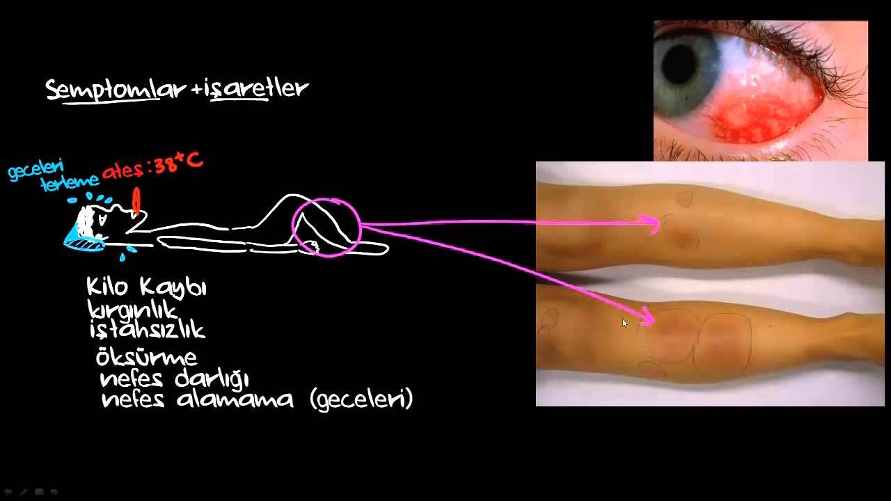 Akciğer Veremi (Sağlık: Verem) (Bulaşıcı Hastalıklar)