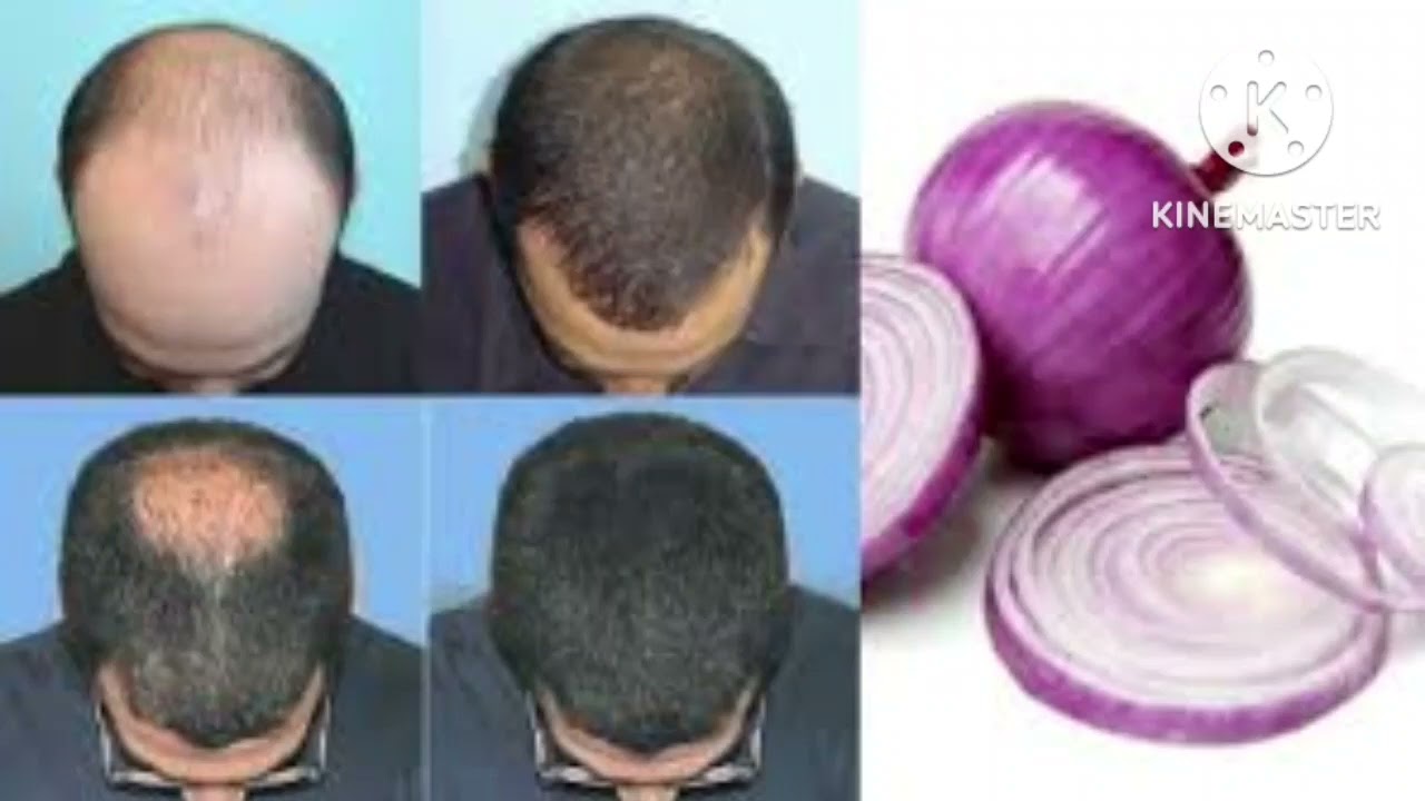 onion juice for hair/biyaha basasha mexey utaraan timaha